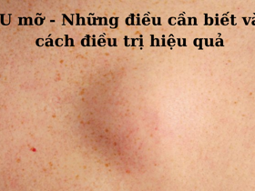 U mỡ - Những điều cần biết và cách điều trị hiệu quả